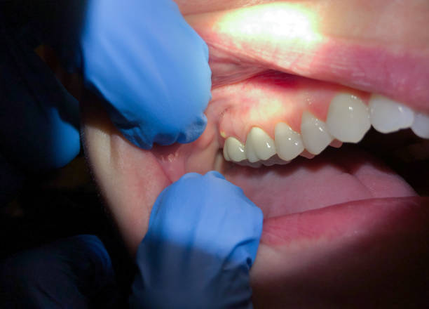 Best Emergency Care for Gum Disease in Center, CO